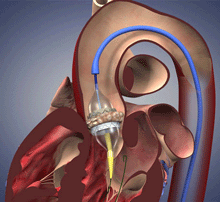 TAVR-catheter