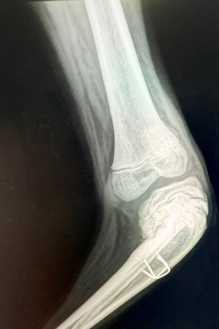 Knee of a 14-year-old boy with a severe varus deformity of his proximal tibia