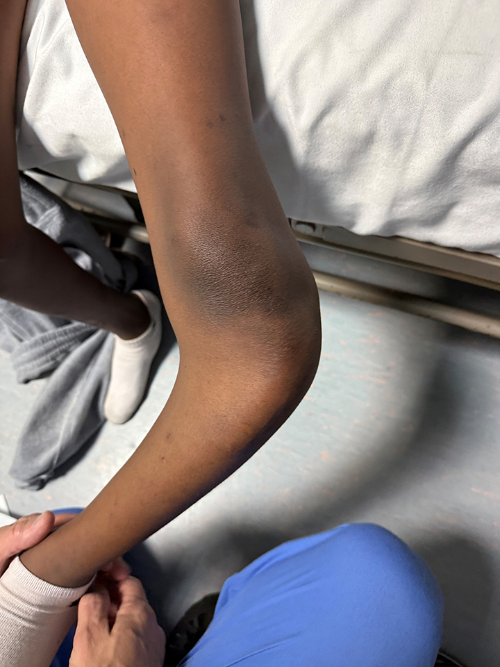 Knee of a 14-year-old boy with a severe varus deformity of his proximal tibia