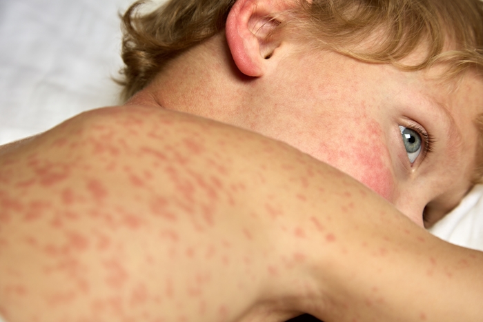 measles