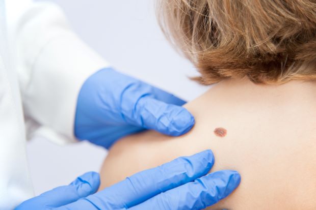 A provider examines a mole on a patient's shoulder to evaluate for melanoma