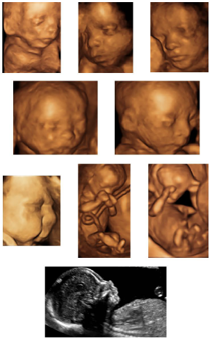 3-D Ultrasound