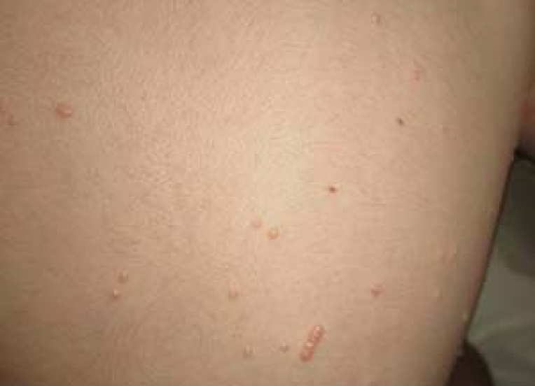 Child's torso with molluscum bumps