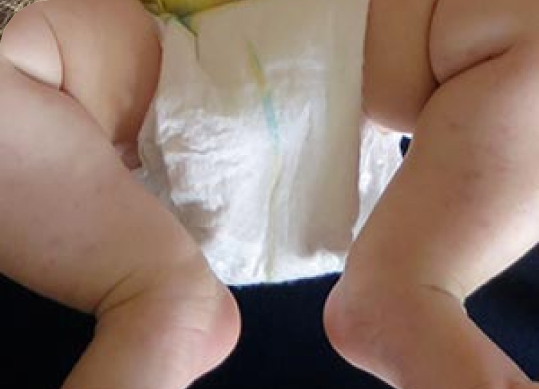 Blue line on a baby's diaper