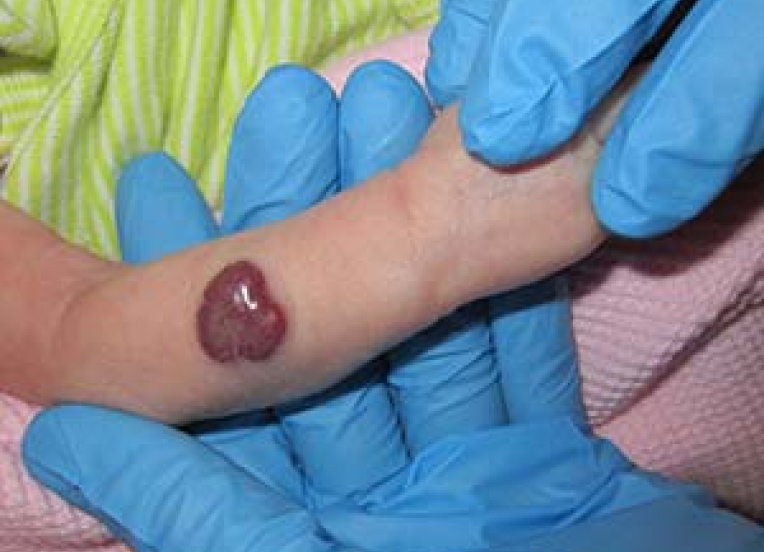 Infants arm with port wine birthmark