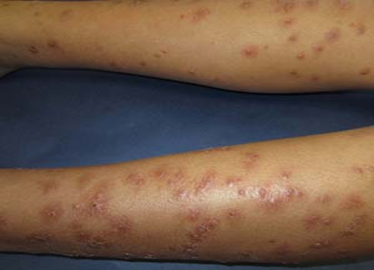 Individual's legs with red bumps