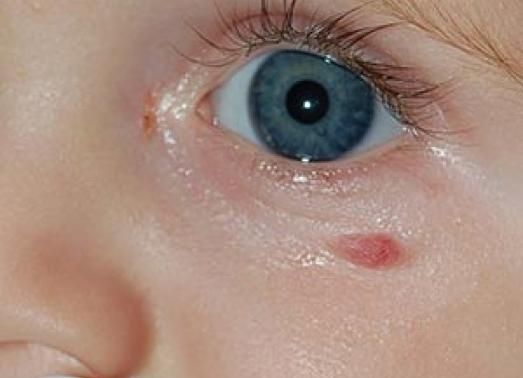 Young child's eye with a mark below it