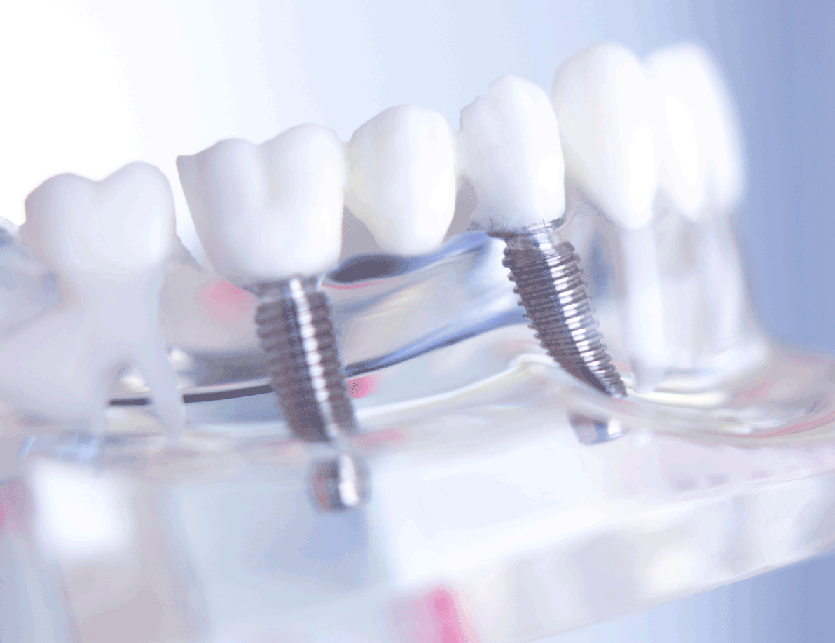 Graphic of dental implants