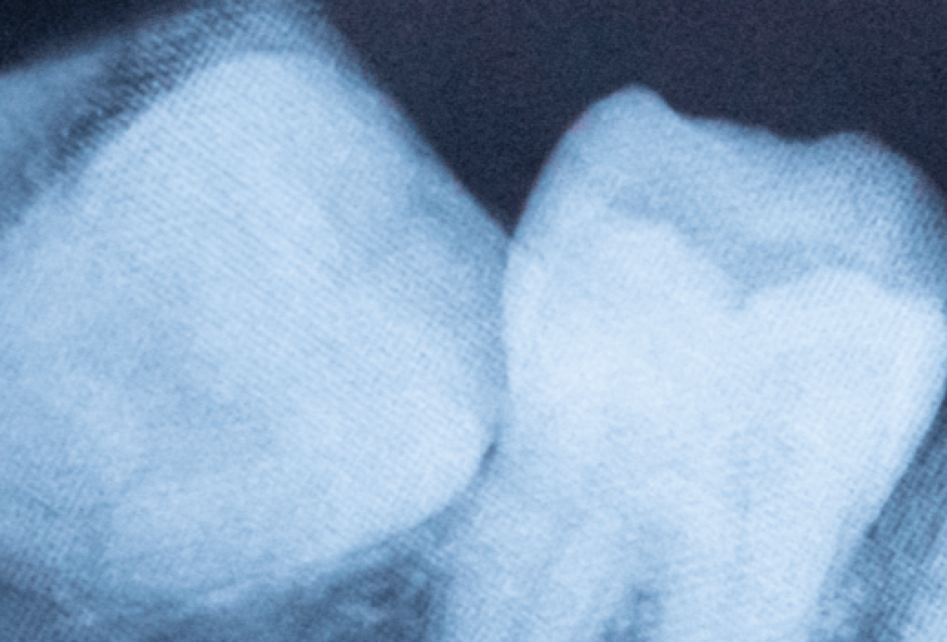 X-ray of teeth