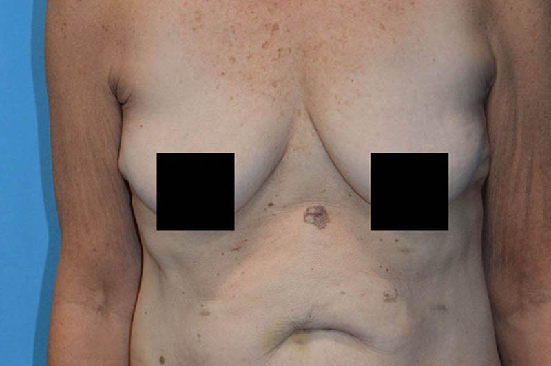 Breast augmentation before photo 1