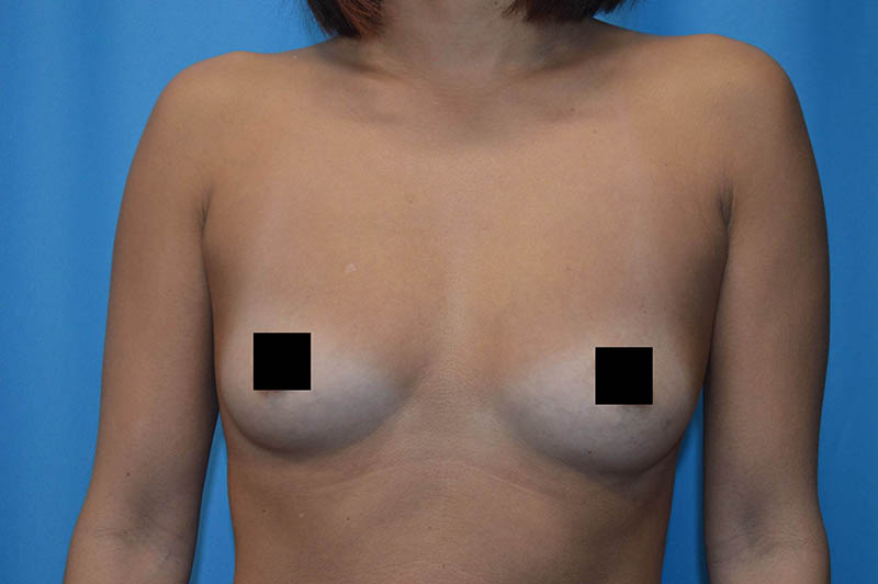 Breast augmentation before photo 3