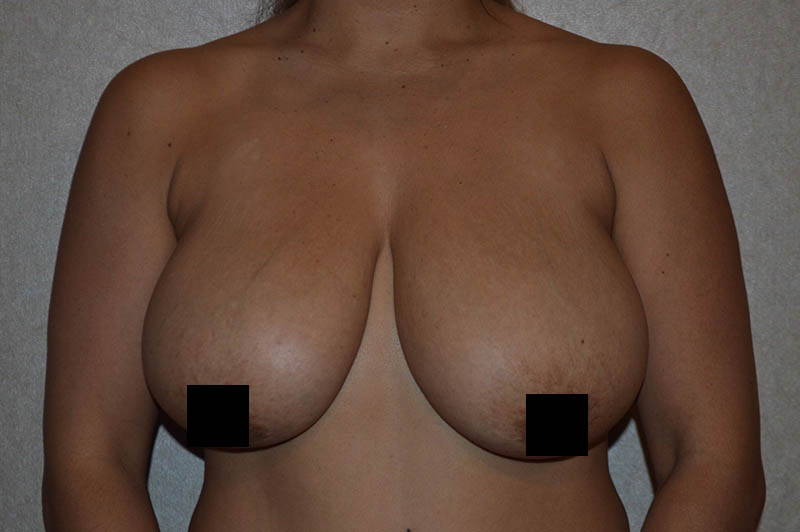 Breast reduction before photo 3