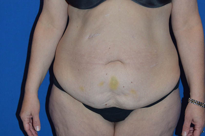 Lower body lift before photo 1