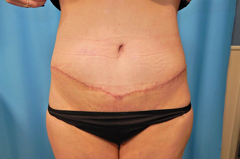 Lower body lift after photo 1