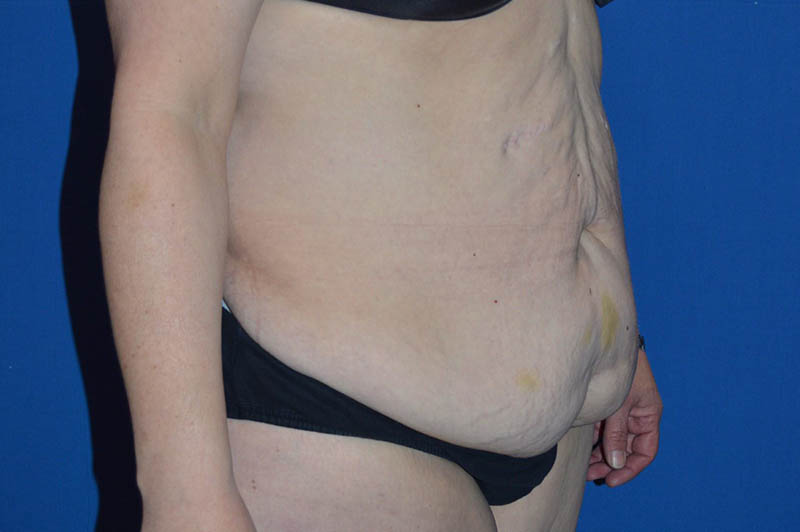 Lower body lift before photo 2