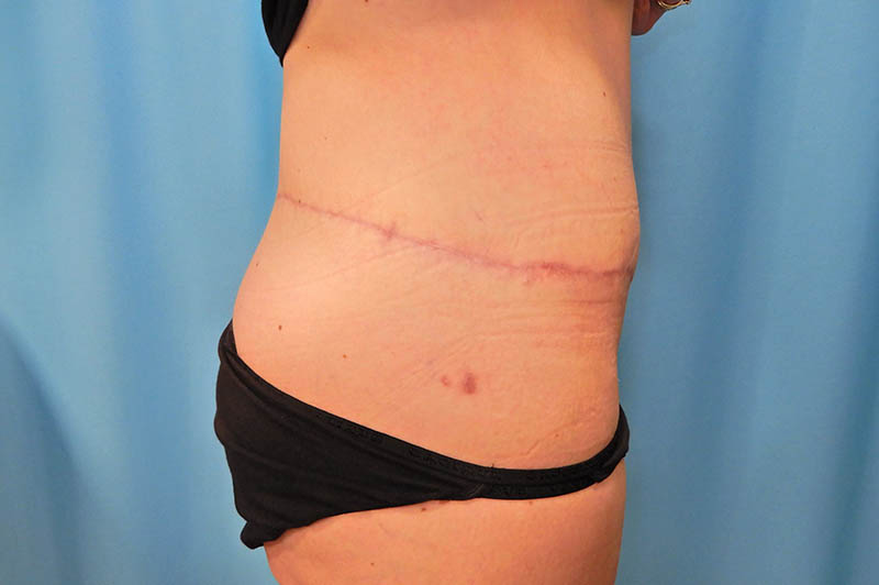 Lower body lift after photo 2