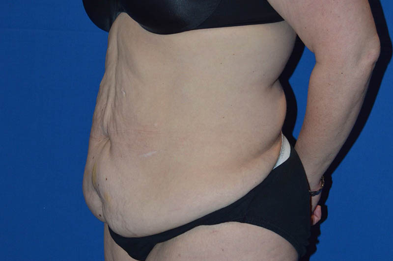 Lower body lift before photo 3