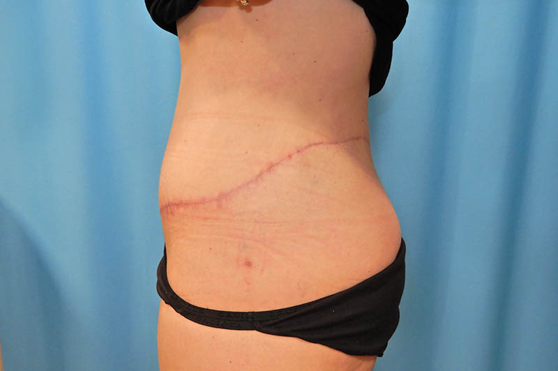 Lower body lift after photo 3