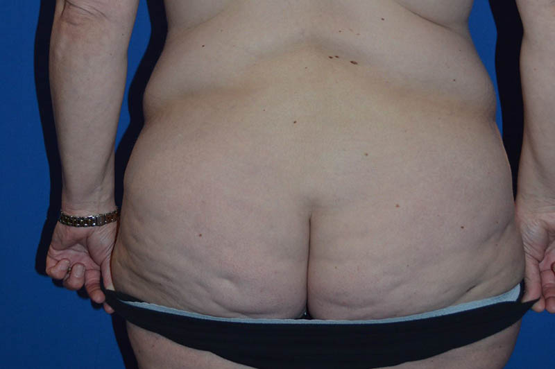 Lower body lift before photo 4