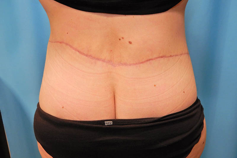 Lower body lift after photo 4