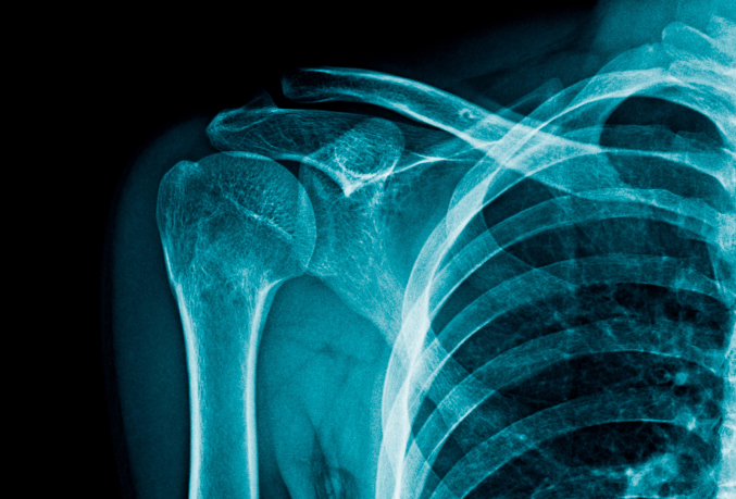 X-Ray of a shoulder